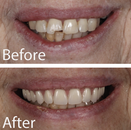 Patient Gallery - Great Neck's Top Dental Implant Solution | Great Neck ...